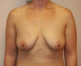 Breast Augmentation San Diego Case 70 - before