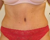 Tummy Tuck Case 1 - after