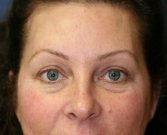Eyelid Surgery San Diego Case 50 - before