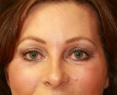 Eyelid Surgery San Diego Case 50 - after