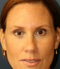 Botox-Dysport-Xeomin - after