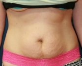TummyTuckSanDiego Case 43 - before