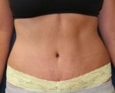 TummyTuckSanDiego Case 43 - after