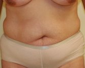 Tummy Tuck Case 17 - before
