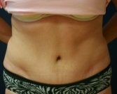 Tummy Tuck Case 17 - after