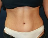 TummyTuckSanDiego Case 45 - after