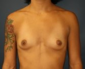 Breast Augmentation San Diego Case 77 - before
