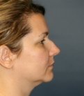 Rhinoplasty San Diego Case 36 - before