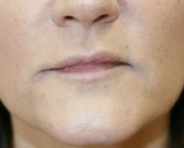 Filler in frown lines San Diego - after