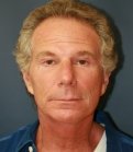 facelift-san-diego-case-24 - after