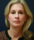 Facelift-San-Diego-Case-16 - before