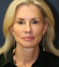 Facelift-San-Diego-Case-16 - after