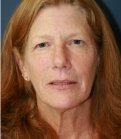 Facelift-San-Diego-Case-26 - before
