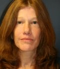 Facelift-San-Diego-Case-26 - after