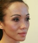 Rhinoplasty 38 (after 2 weeks) - before