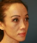 Rhinoplasty 38 (after 2 weeks) - after