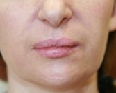Juvederm in Nasal-labial-folds-San-Diego - before
