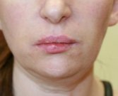 Juvederm in Nasal-labial-folds-San-Diego - after