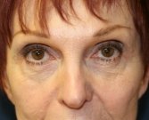 Injectable Filler in Lower Eyelids - before