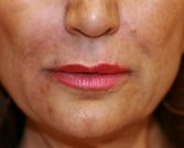 Hyaluronan gel (Juvederm) around lips - after
