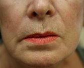 Hyaluronan gel (Expression) around lips - before