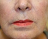 Hyaluronan gel (Expression) around lips - after