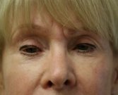 Expression gel San Diego in Lower Eyelids - after