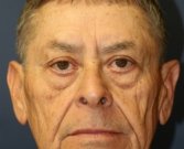Eyelid Surgery San Diego 52 - before