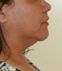 Necklift Case 7 - before