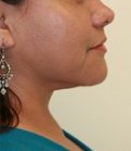 Necklift Case 7 - after
