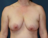 Breast Lift San Diego 20 - before
