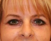 Blepharoplasty Case 3 - after