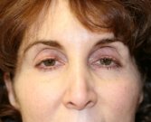 Eyelid Surgery San Diego 53 - before
