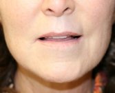 Lip lift and corner lift 22 - before