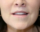Lip lift and corner lift 22 - after