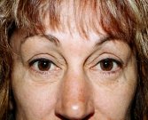 Blepharoplasty Case 4 - before
