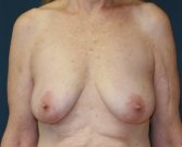 Breast Lift San Diego 21 - before