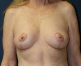 Breast Lift San Diego 21 - after