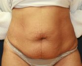 Tummy Tuck San Diego 47 - before