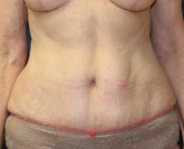 Tummy Tuck San Diego 48 - after