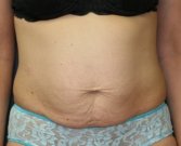 Tummy Tuck San Diego 49 - before