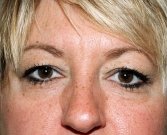 Blepharoplasty Case 5 - before