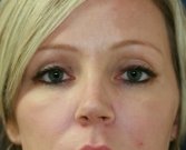 eye-lift-san-diego-57 - before