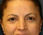 eye-lift-san-diego-59 - after