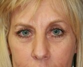 eye-lift-san-diego-61 - before