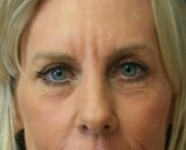 eye-lift-san-diego-61 - after