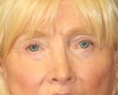 eye-lift-san-diego-62 - after