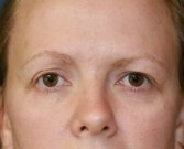 Eyelid-Lift-San-Diego-63 - before