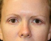 Eyelid-Lift-San-Diego-63 - after