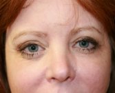 Eyelid-Lift-San-Diego-64 - before